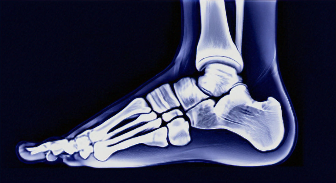Understanding Plantar Fasciitis and How to Treat It