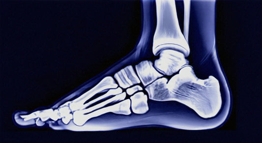 Understanding Plantar Fasciitis and How to Treat It